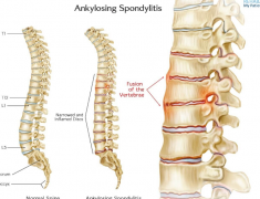 �����İ�֢ǿֱ��Ҫ����֢�ַ�����Ϊ��Ҫ����