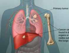 PD-1���Ƽ�Keytruda������Ϊ���ڷΰ�������ѡ