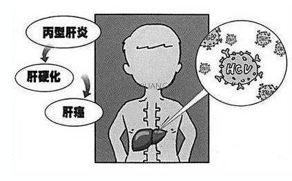 丙肝传染途径 丙肝传染途径