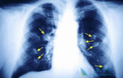 �ΰ����ڵ�֢״��Ҫ����Ϊ����˻��