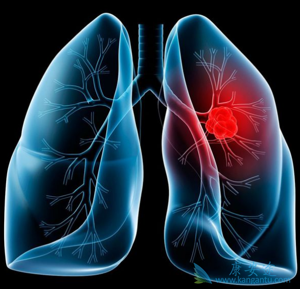 治疗肺癌的方法 治疗肺癌的方法