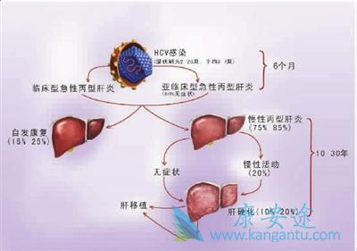 丙肝的危害 丙肝的危害