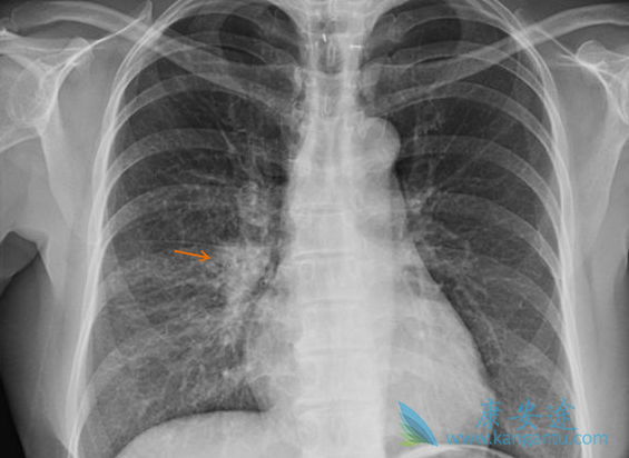 非小细胞肺癌 非小细胞肺癌