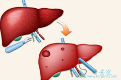 HCV/HBV����Ⱦ�ĸ�Ӳ�����߱�����ô����