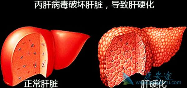 丙肝治疗 丙肝治疗
