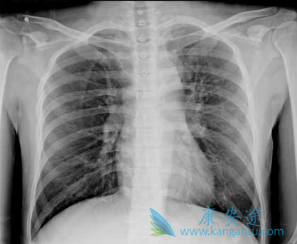 晚期肺癌治疗 晚期肺癌治疗