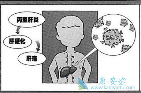 丙肝能结婚吗 丙肝能结婚吗