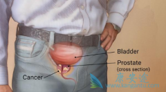 ��Ƶ���Ƿǳ�������ǰ���ٰ�֢״