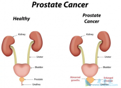 ���������Ƿǳ����͵�����ǰ���ٰ�֢״