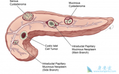 ������һ�ֳ����ĵ������ٰ�֢״