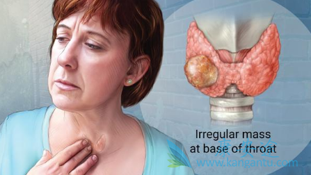 甲状腺肿大是非常常见的早期甲状腺癌症状