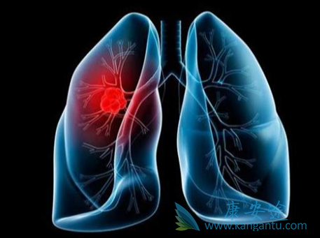 肺癌术后饮食 肺癌术后饮食