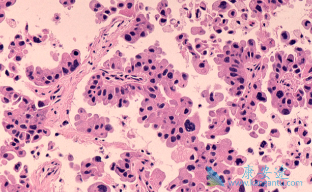 肺癌腺癌 肺癌腺癌