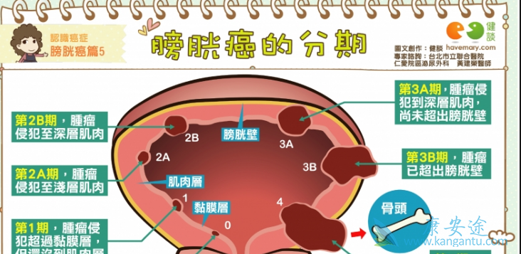 血尿是最常见的膀胱癌症状之一