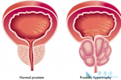 ǰ���ٰ�֢��ָ������ǰ���ٵ���Ƥ�Զ�������