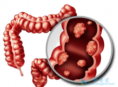 ���ڴ󳦰�֢״���̴��Ƚ���