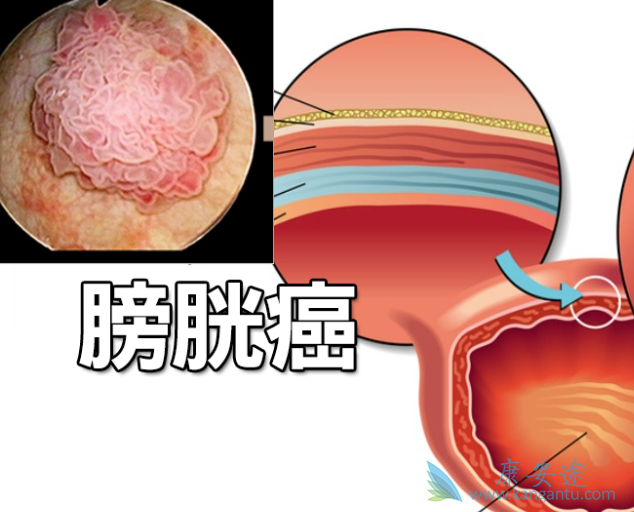 康安途海外医疗 肿瘤新闻 血尿的出现是膀胱癌症状之一   膀胱癌,可能
