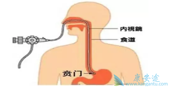 贲门癌症状 贲门癌症状