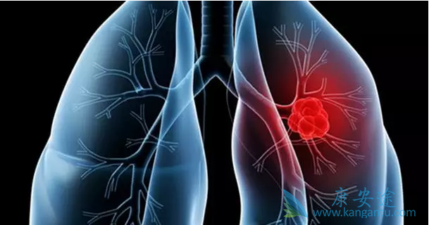 肺癌晚期吃什么好 肺癌晚期吃什么好