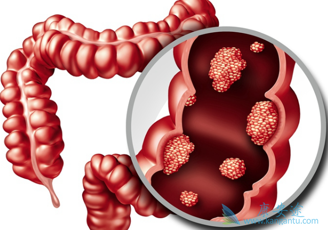 大肠癌症状 大肠癌症状