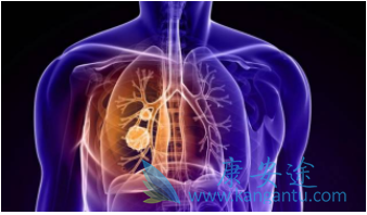 肺癌手术费用多少 肺癌手术费用多少