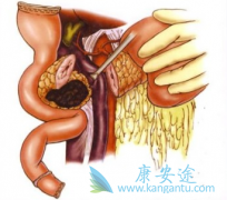 ���߳����ǲ�˹��֢���ٰ�֢״���ܻ���