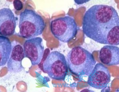 ʲô�Ƕ෢�Թ��������෢�Թ�������֢״����Щ��