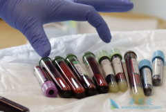 CAR-Tϸ�����Ʒ�������ѪҺ�������Ƶõ��˺ܺõ���Ч