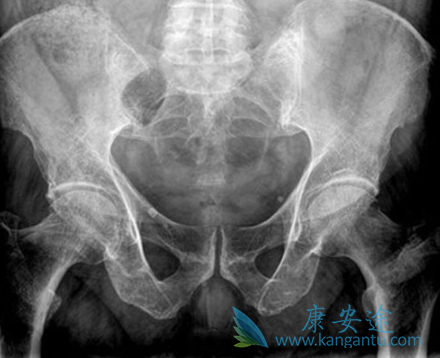 多发性骨髓瘤的症状 多发性骨髓瘤的症状