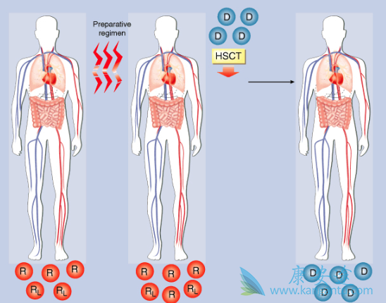 什么是多发性骨髓瘤 什么是多发性骨髓瘤