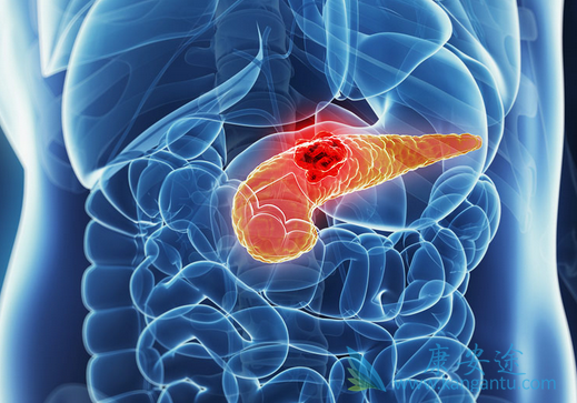 治疗胰腺癌 治疗胰腺癌
