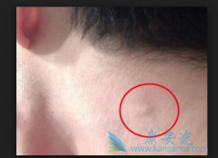 �����ܰͰ�ԭ������Щ���ܰͰ�֢״����Щ