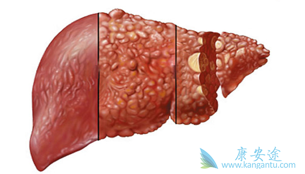 肝癌晚期能活多久 肝癌晚期能活多久