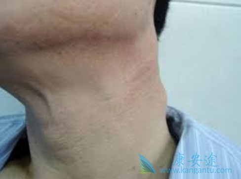 淋巴癌治疗方案 淋巴癌治疗方案