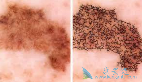 黑色素瘤和痣的区别 黑色素瘤和痣的区别