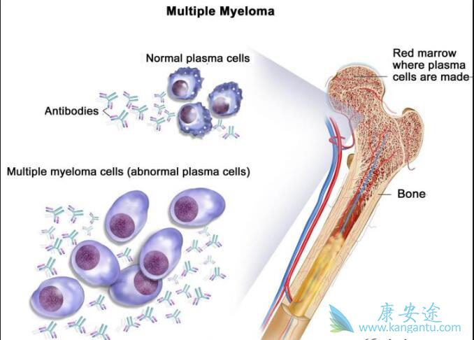多发性骨髓瘤 多发性骨髓瘤