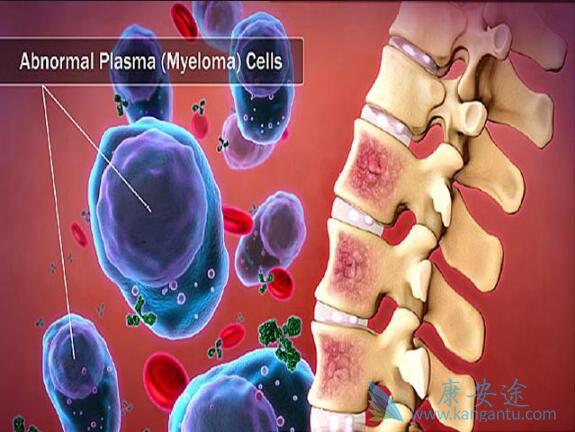 多发性骨髓瘤 多发性骨髓瘤