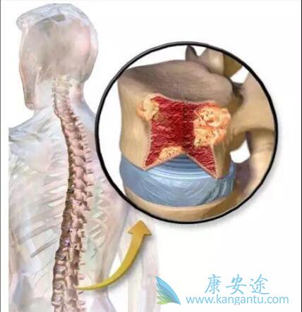多发性骨髓瘤 多发性骨髓瘤