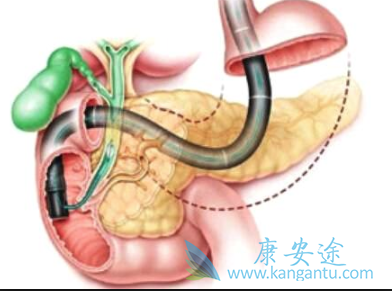 治疗胰腺癌 治疗胰腺癌