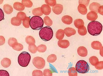 白血病病因 白血病病因