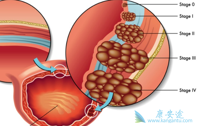 膀胱癌症状 膀胱癌症状