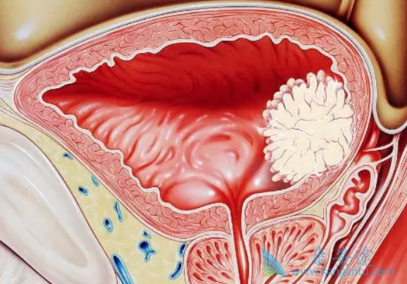 膀胱癌症状 膀胱癌症状