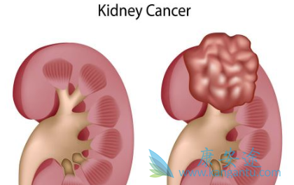 肾癌症状 肾癌症状