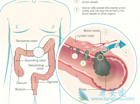 大肠癌症状 大肠癌症状