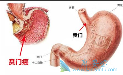 贲门癌症状 贲门癌症状