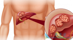 ǧ��������Ҹβ���Я���߻ᴫȾ�������