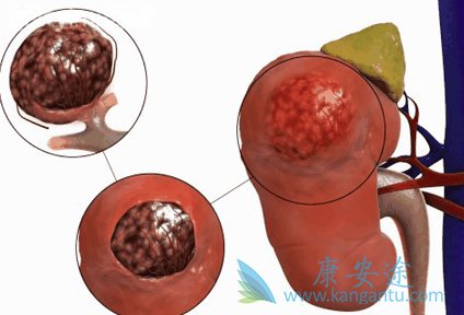 舒尼替尼 舒尼替尼