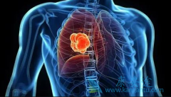 PD-1���Ƽ���Ȭ��(pembrolizumab)����������Էΰ��ķ�Ӧ��