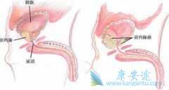 ����³��(Xtandi)����ǰ���ٰ�Ч����ô�������Գ��ڷ�����