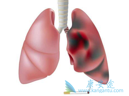 肺癌晚期症状 肺癌晚期症状